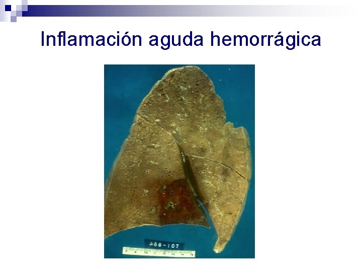 Inflamación aguda hemorrágica 
