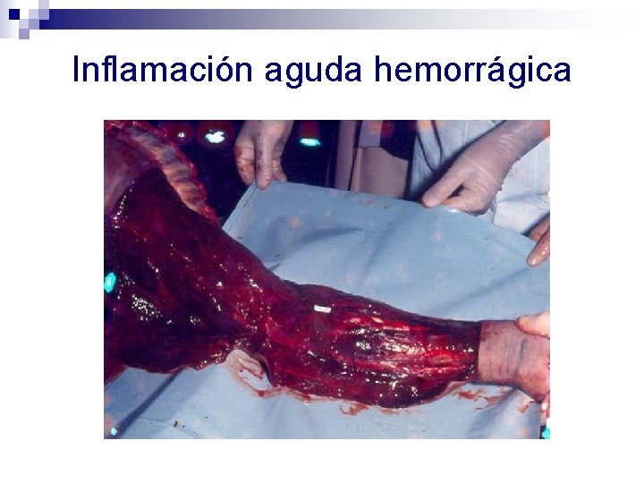 Inflamación aguda hemorrágica 