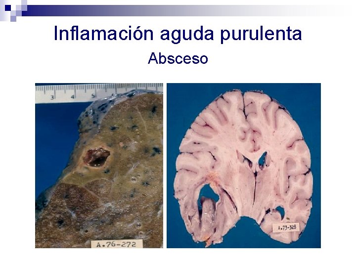 Inflamación aguda purulenta Absceso 