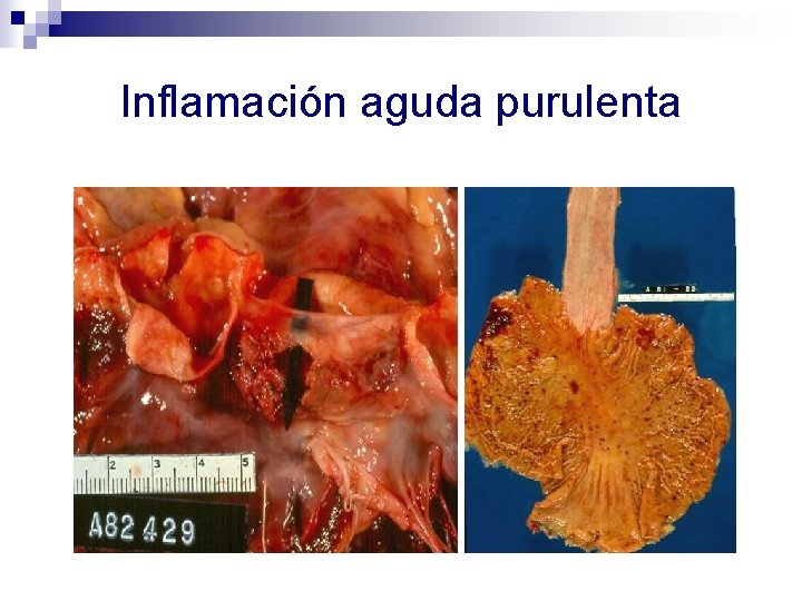 Inflamación aguda purulenta 