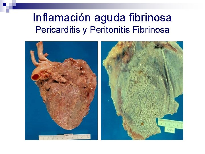 Inflamación aguda fibrinosa Pericarditis y Peritonitis Fibrinosa 