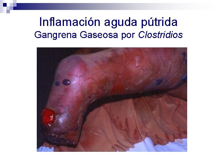 Inflamación aguda pútrida Gangrena Gaseosa por Clostridios 