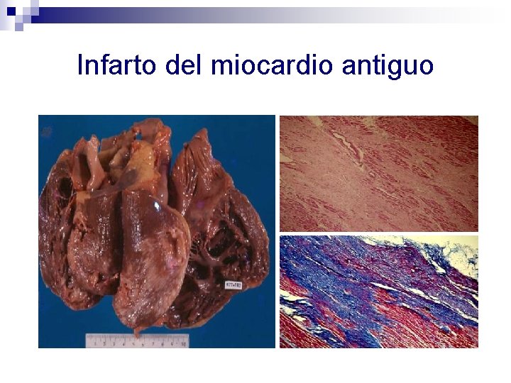 Infarto del miocardio antiguo 