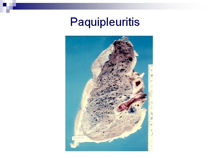 Paquipleuritis 