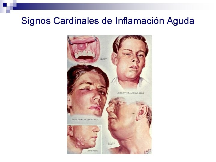 Signos Cardinales de Inflamación Aguda 