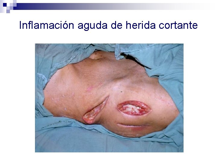 Inflamación aguda de herida cortante 