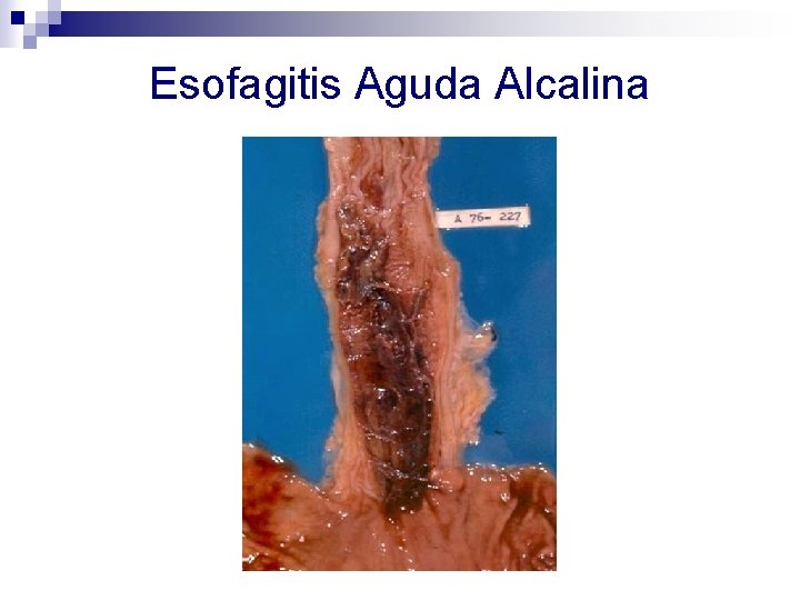Esofagitis Aguda Alcalina 