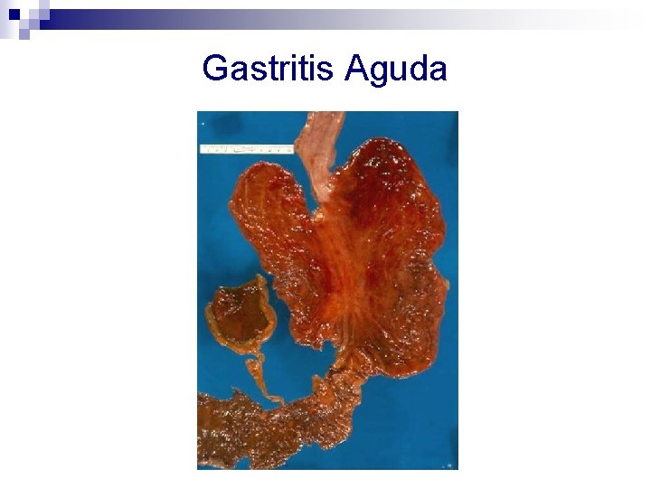 Gastritis Aguda 
