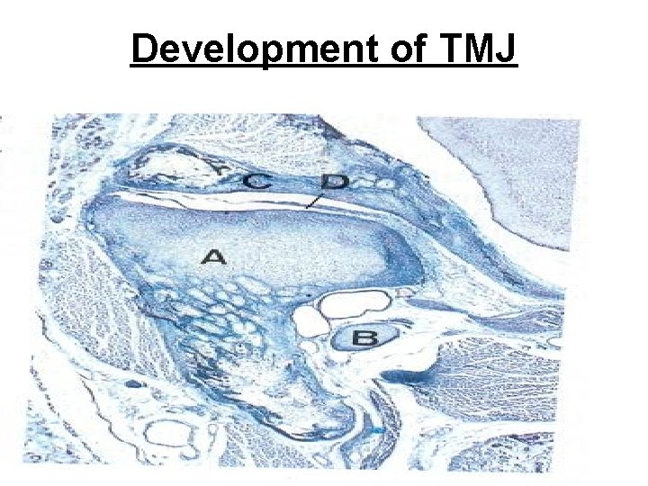 Development of TMJ 