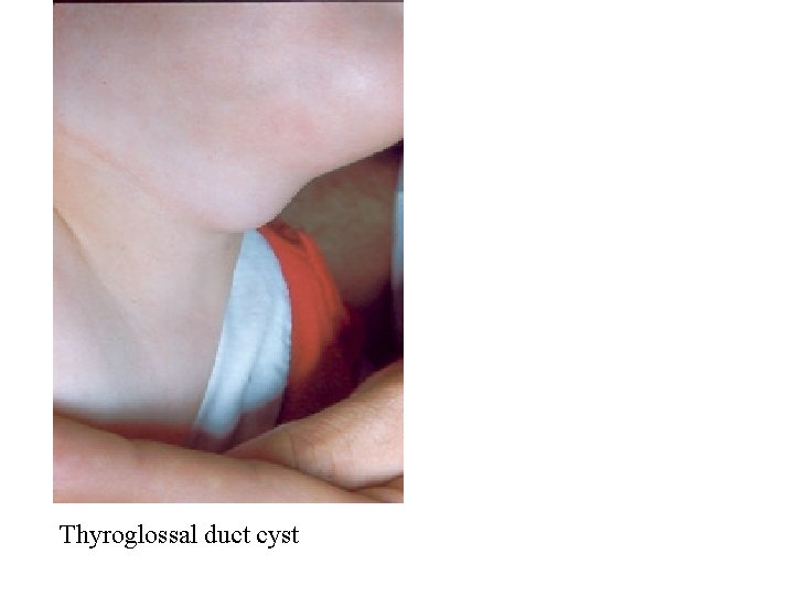 Thyroglossal duct cyst 