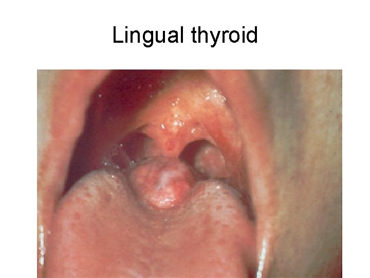 Lingual thyroid 