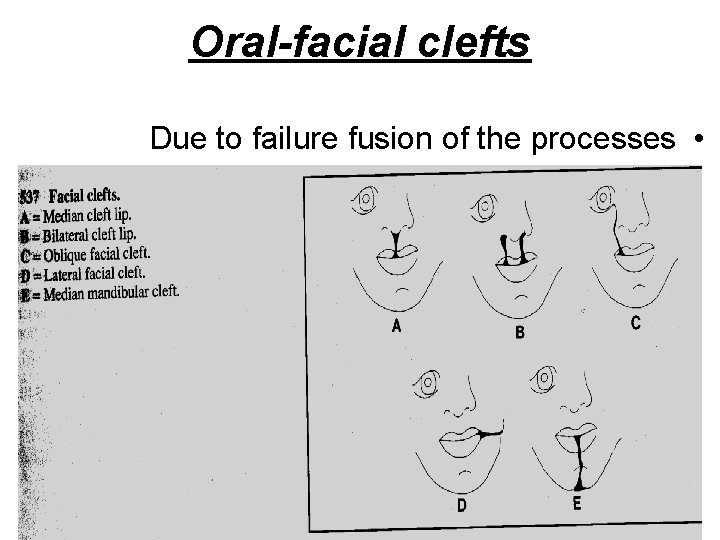 Oral-facial clefts Due to failure fusion of the processes • 