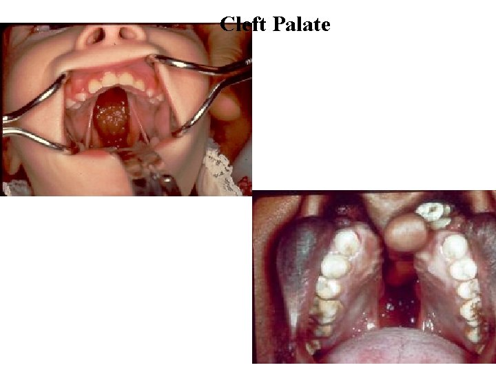 Cleft Palate 