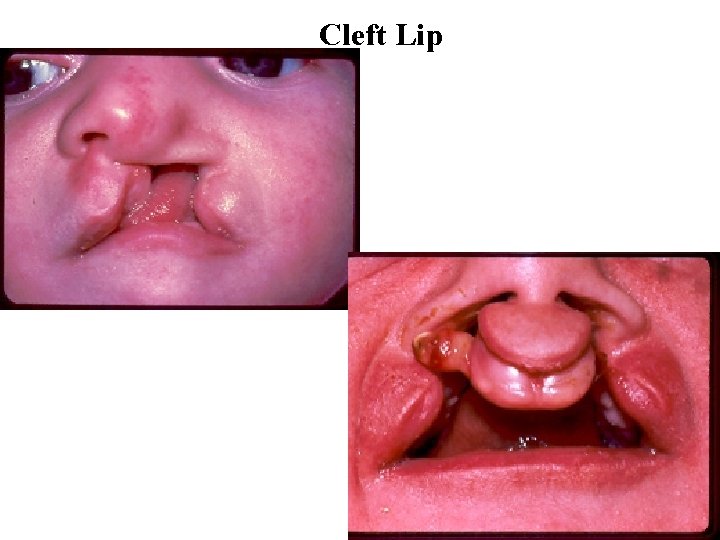 Cleft Lip 