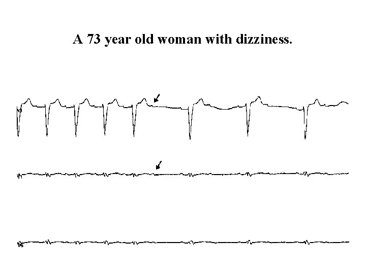 A 73 year old woman with dizziness. A 73 year old woman with dizziness.