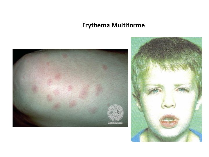 Erythema Multiforme 