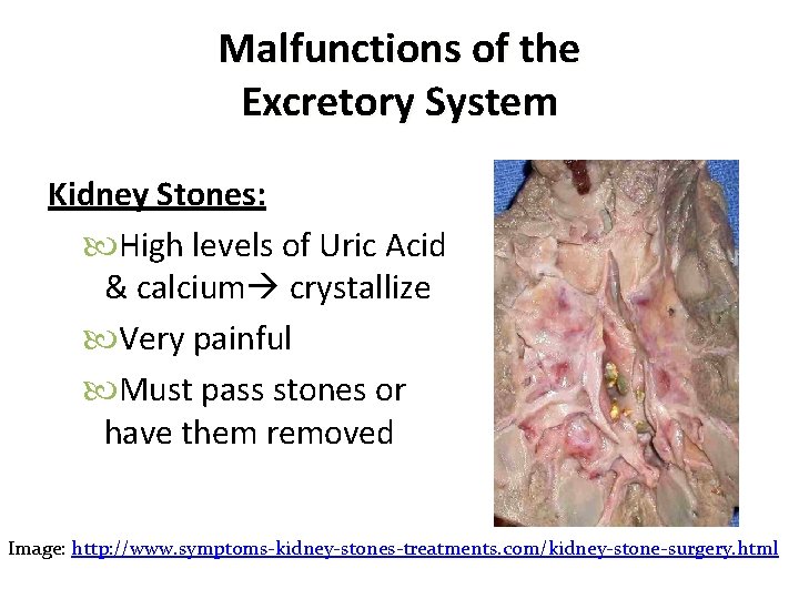 Malfunctions of the Excretory System Kidney Stones: High levels of Uric Acid & calcium