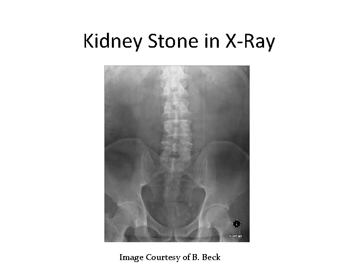 Kidney Stone in X-Ray Image Courtesy of B. Beck 