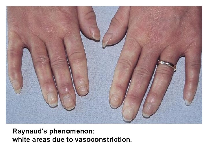 Raynaud's phenomenon: white areas due to vasoconstriction. 