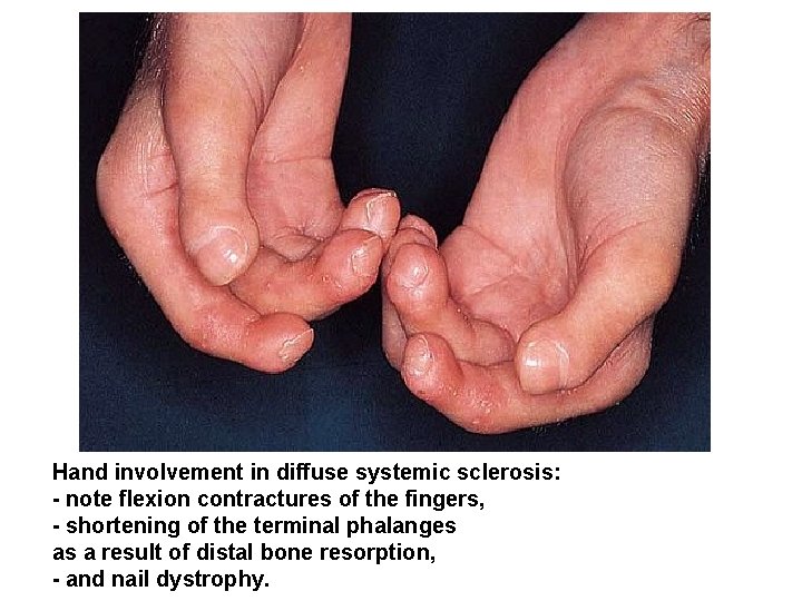 Hand involvement in diffuse systemic sclerosis: - note flexion contractures of the fingers, -