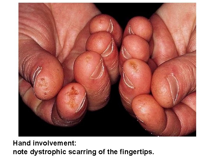 Hand involvement: note dystrophic scarring of the fingertips. 