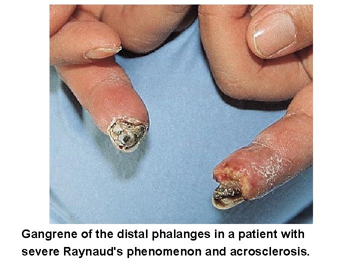 Gangrene of the distal phalanges in a patient with severe Raynaud's phenomenon and acrosclerosis.