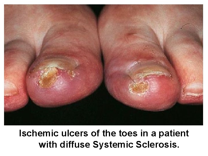 Ischemic ulcers of the toes in a patient with diffuse Systemic Sclerosis. 