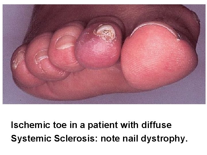 Ischemic toe in a patient with diffuse Systemic Sclerosis: note nail dystrophy. 