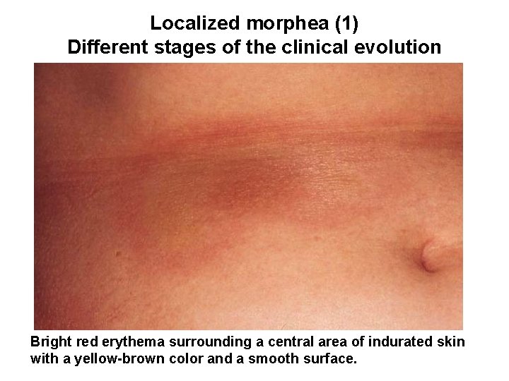 Localized morphea (1) Different stages of the clinical evolution Bright red erythema surrounding a