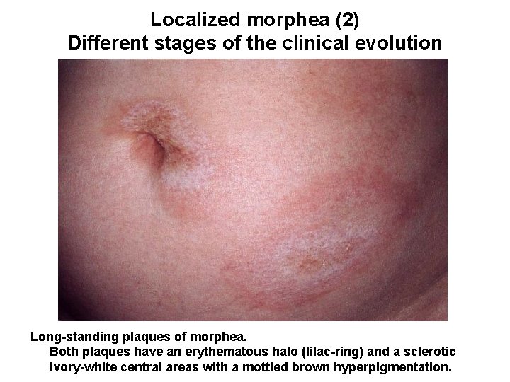 Localized morphea (2) Different stages of the clinical evolution Long-standing plaques of morphea. Both
