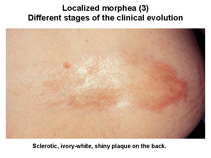 Localized morphea (3) Different stages of the clinical evolution Sclerotic, ivory-white, shiny plaque on