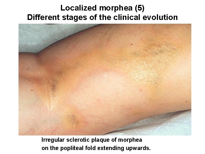 Localized morphea (5) Different stages of the clinical evolution Irregular sclerotic plaque of morphea