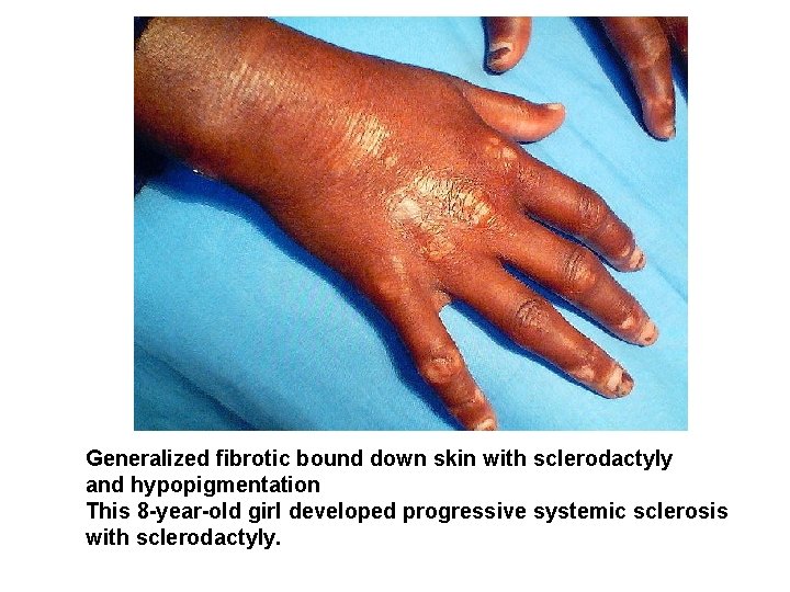 Case Generalized fibrotic bound down skin with sclerodactyly and hypopigmentation This 8 -year-old girl