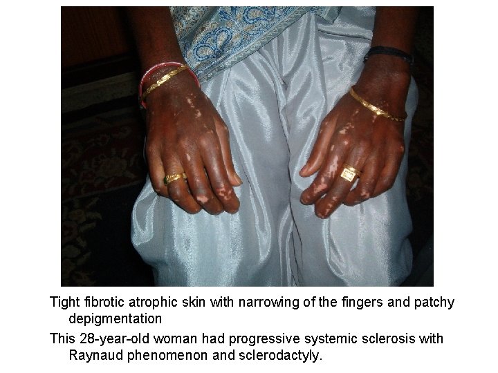 Tight fibrotic atrophic skin with narrowing of the fingers and patchy depigmentation This 28