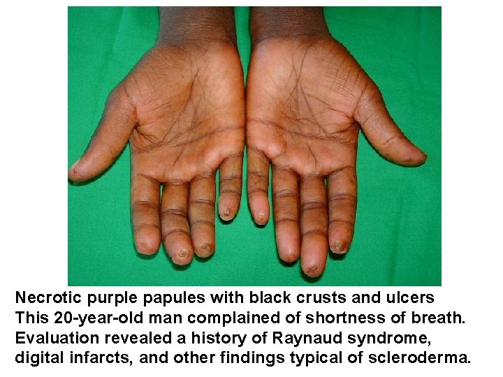 Necrotic purple papules with black crusts and ulcers This 20 -year-old man complained of