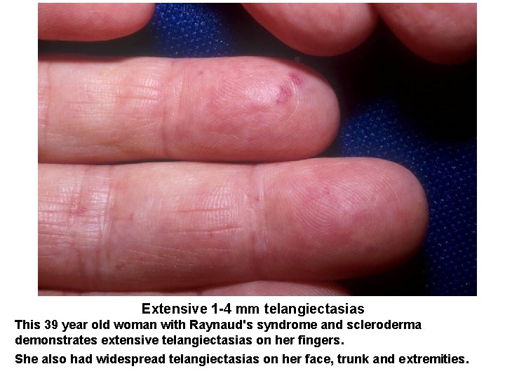 Extensive 1 -4 mm telangiectasias This 39 year old woman with Raynaud's syndrome and