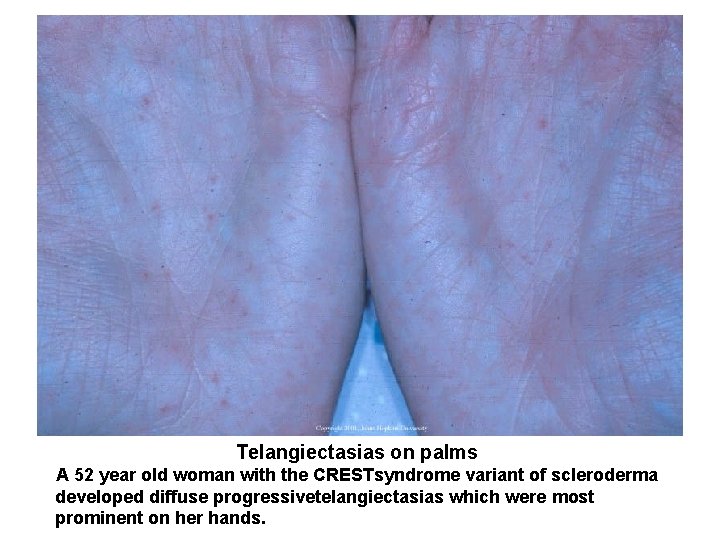 Telangiectasias on palms A 52 year old woman with the CRESTsyndrome variant of scleroderma