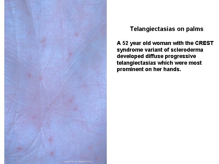 Telangiectasias on palms A 52 year old woman with the CREST syndrome variant of