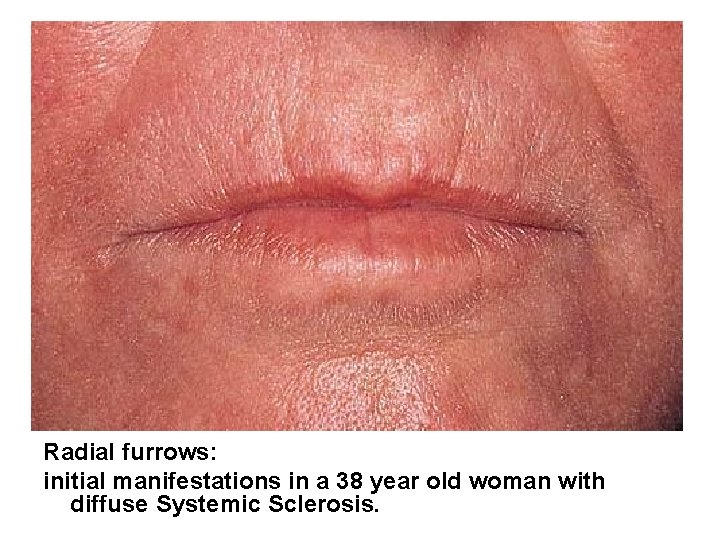 Radial furrows: initial manifestations in a 38 year old woman with diffuse Systemic Sclerosis.
