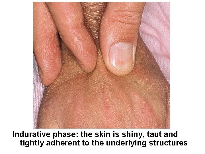 Indurative phase: the skin is shiny, taut and tightly adherent to the underlying structures