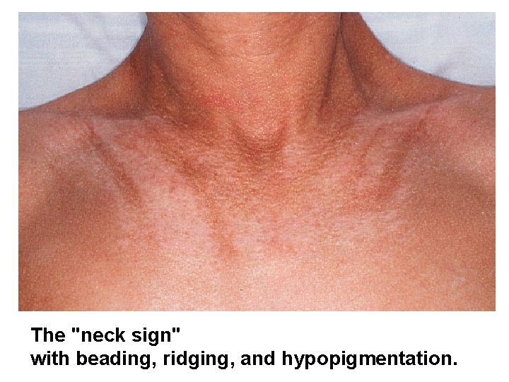 The "neck sign" with beading, ridging, and hypopigmentation. 