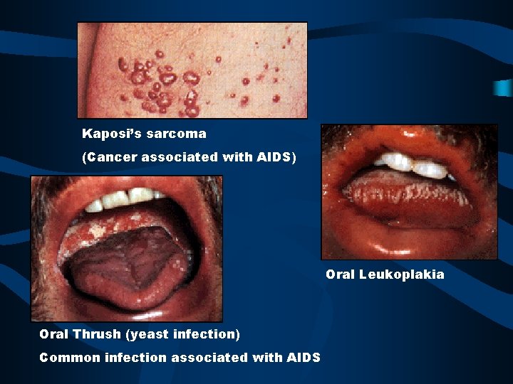 Kaposi’s sarcoma (Cancer associated with AIDS) Oral Leukoplakia Oral Thrush (yeast infection) Common infection
