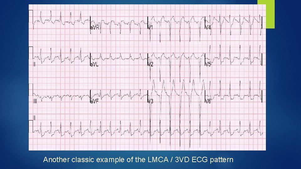 Another classic example of the LMCA / 3 VD ECG pattern 