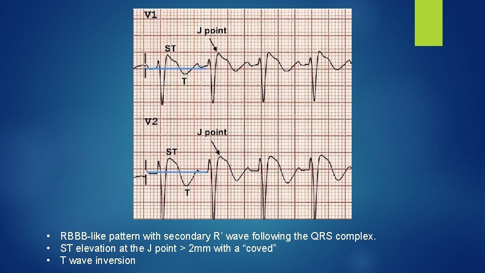  • RBBB-like pattern with secondary R’ wave following the QRS complex. • ST