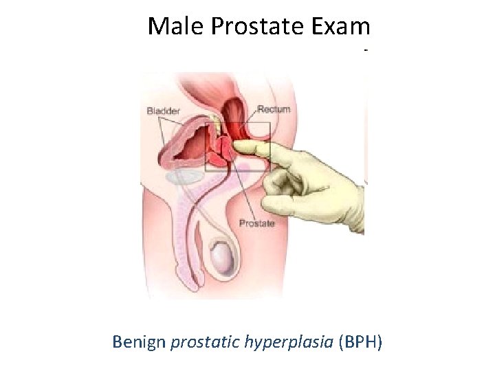 Male Prostate Exam Benign prostatic hyperplasia (BPH) 