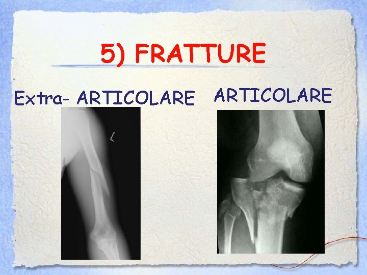 5) FRATTURE Extra- ARTICOLARE 