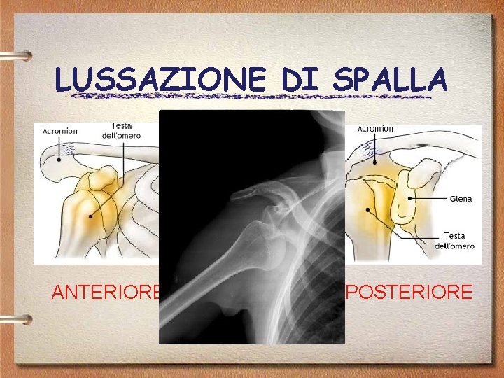 LUSSAZIONE DI SPALLA ANTERIORE ANTERO-INF POSTERIORE 