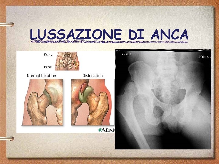 LUSSAZIONE DI ANCA 