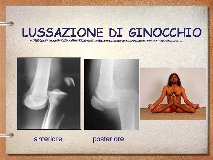 LUSSAZIONE DI GINOCCHIO anteriore posteriore 