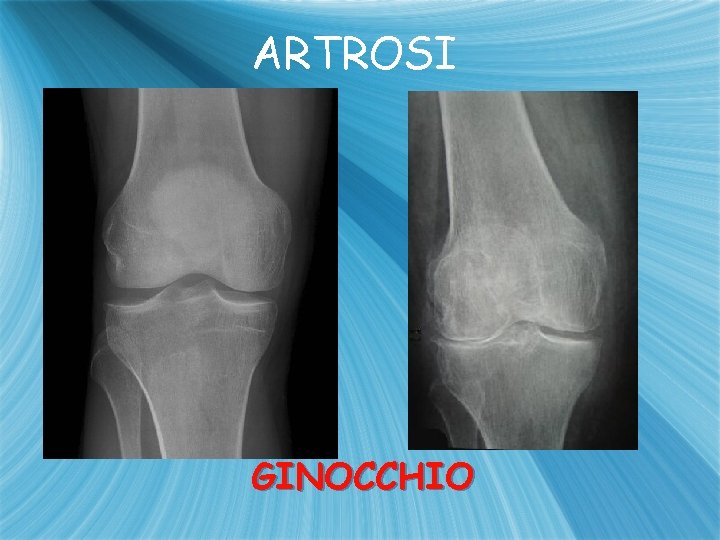 ARTROSI GINOCCHIO 